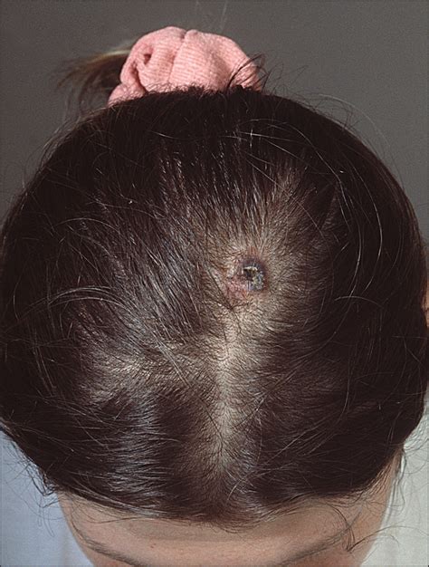 stage 4 melanoma pictures